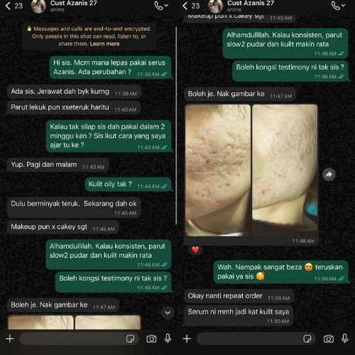 Masalah Parut Jerawat Dah kurang parut lekuk kat muka — Minyak pada kulit muka juga dah kurang — Senang pakai makeup sekarang kurang cakey.